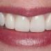 Cosmetic Dentistry - After