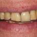 Cosmetic Dentistry Veneers - Before